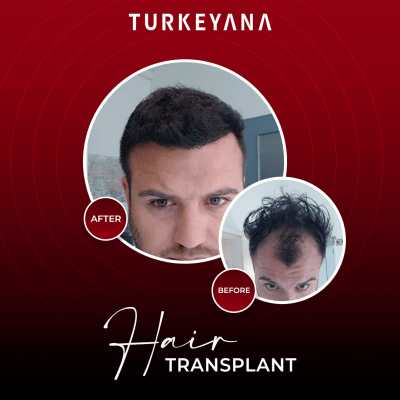 زراعة الشعر-اسطنبول-تركيا