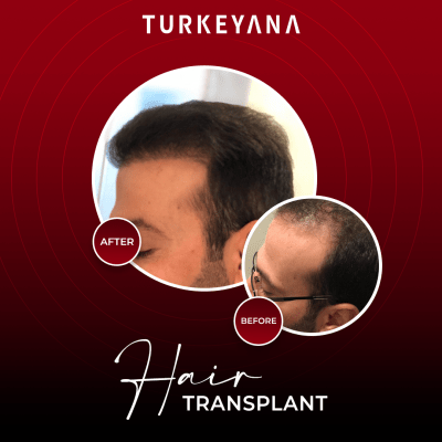 قبل و بعد زراعة الشعر في اسطنبول