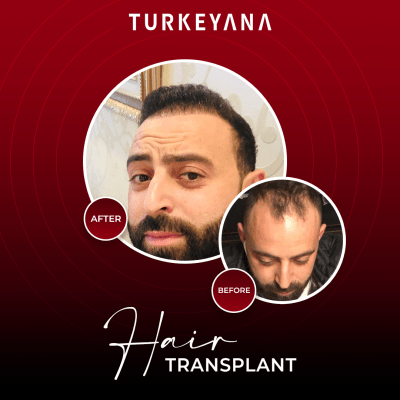 زراعة الشعر-اسطنبول-تركيا