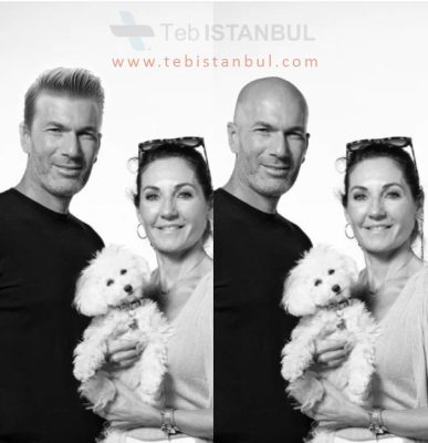 زيدان قبل و بعد زراعة الشعر في اسطنبول