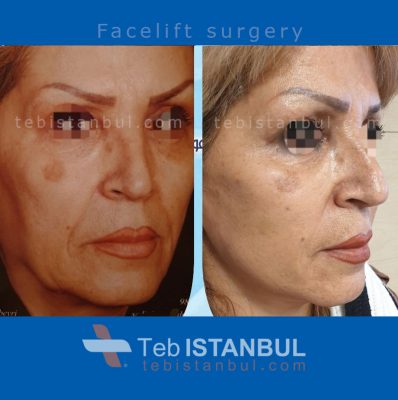 جراحة شد الوجه في تركيا