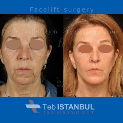 جراحة شد الوجه في تركيا